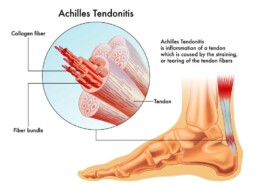 achillis tendonitis