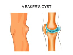 best knee wrap for bakers cyst