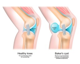 what is a baker's cyst